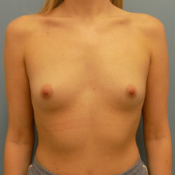 Breast Augmentation - Before and After