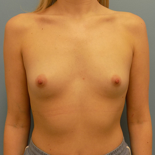 Breast Augmentation - Before and After