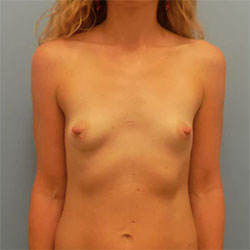 Breast Augmentation - Before and After