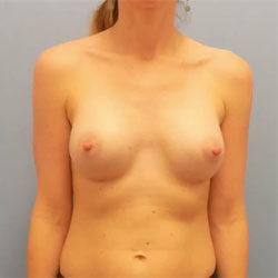 Breast Augmentation - Before and After