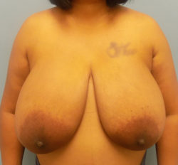 Breast Reduction - Before and After