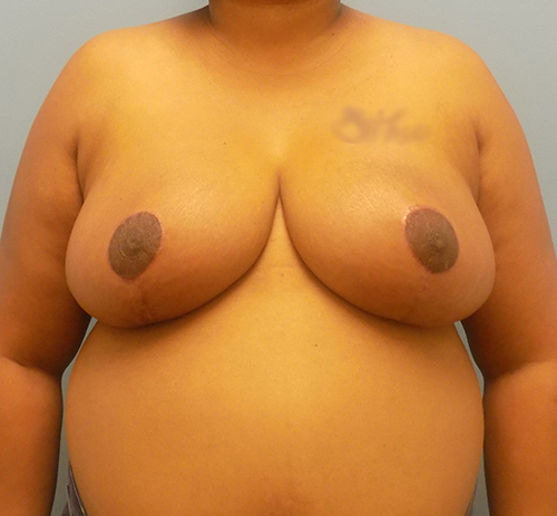 Breast Reduction - Before and After