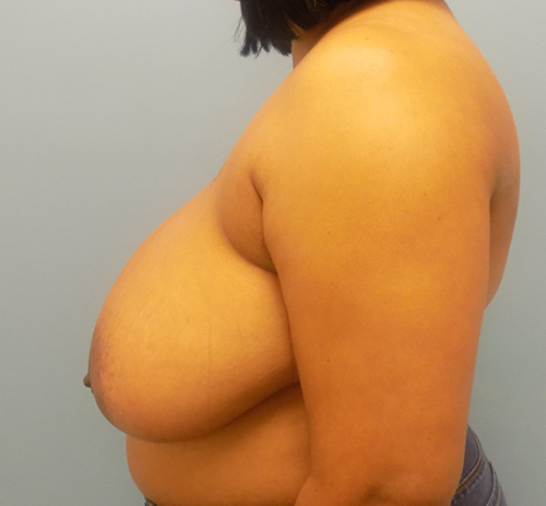 Breast Reduction - Before and After