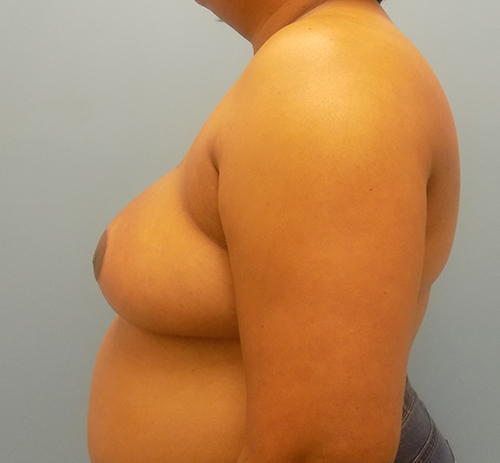 Breast Reduction - Before and After