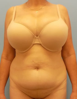 Abdominoplasty (Tummy Tuck) - Before and After