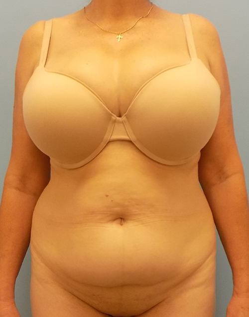 Abdominoplasty (Tummy Tuck) - Before and After