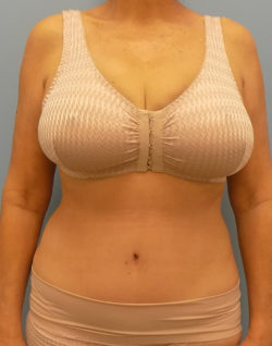Abdominoplasty (Tummy Tuck) - Before and After