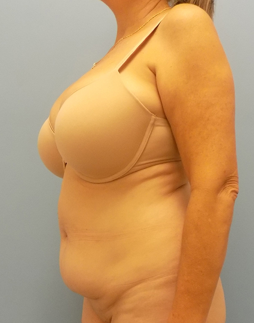 Abdominoplasty (Tummy Tuck) - Before and After