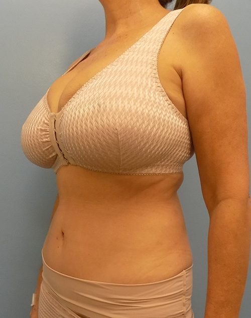 Abdominoplasty (Tummy Tuck) - Before and After