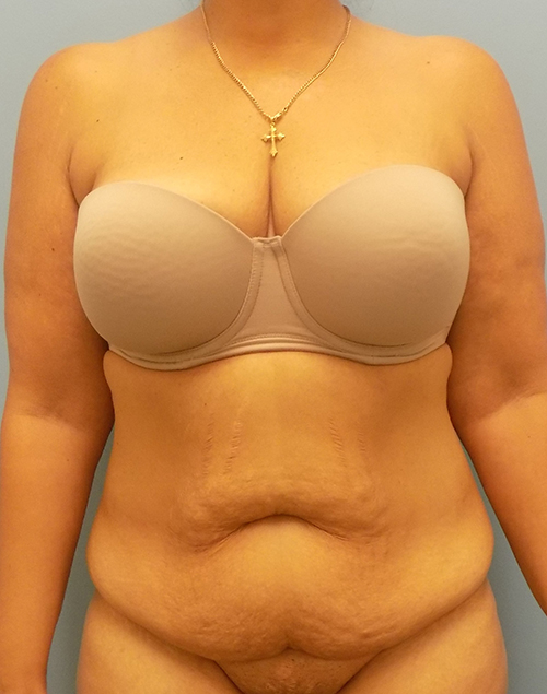Abdominoplasty (Tummy Tuck) - Before and After