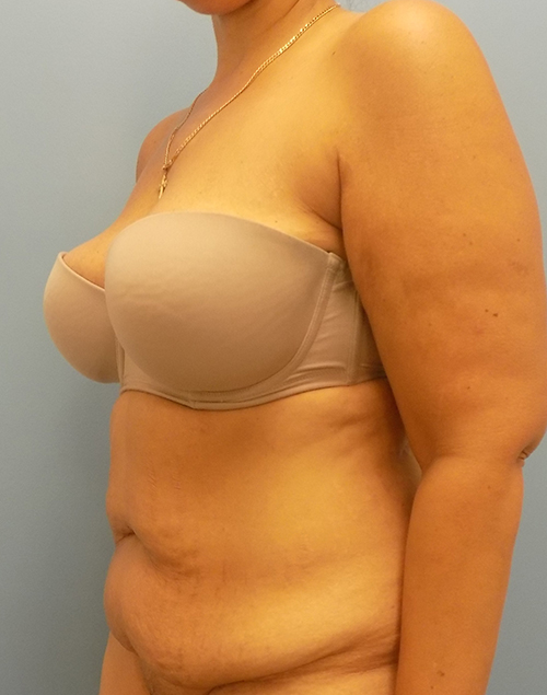 Abdominoplasty (Tummy Tuck) - Before and After