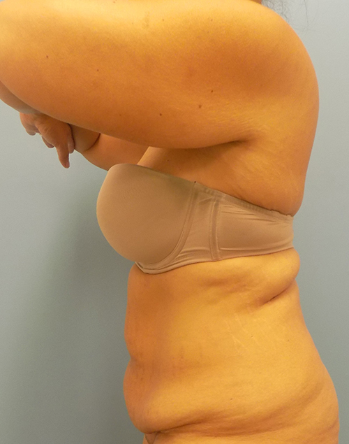 Abdominoplasty (Tummy Tuck) - Before and After