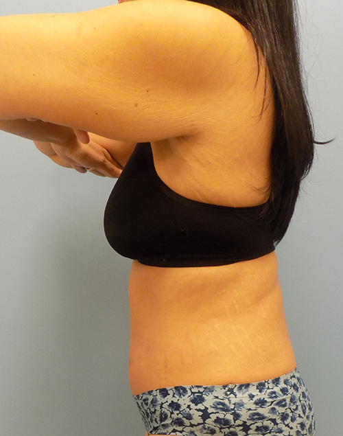 Abdominoplasty (Tummy Tuck) - Before and After