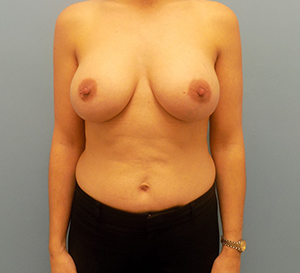 Breast Augmentation - Before and After
