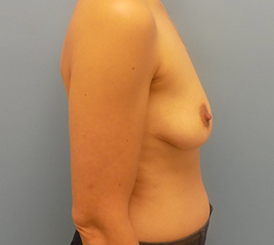 Breast Augmentation - Before and After