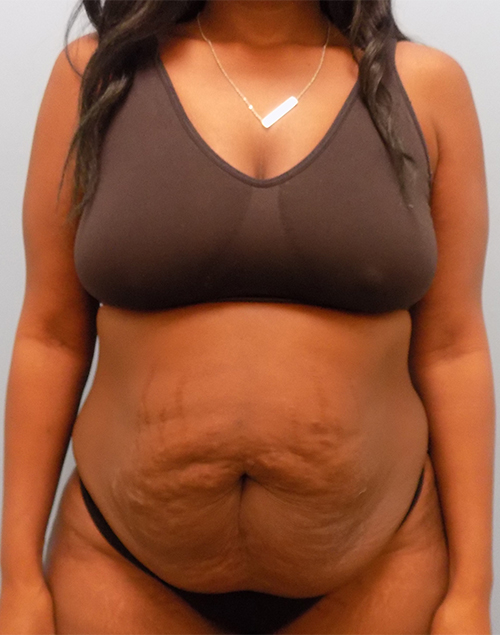 Abdominoplasty (Tummy Tuck) - Before and After