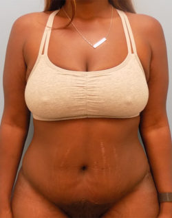 Abdominoplasty (Tummy Tuck) - Before and After