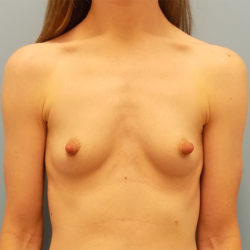 Breast Augmentation - Before and After