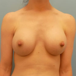 Breast Augmentation - Before and After