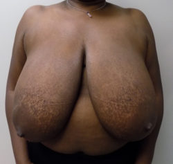 Breast Reduction - Before and After