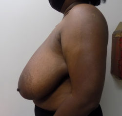 Breast Reduction - Before and After