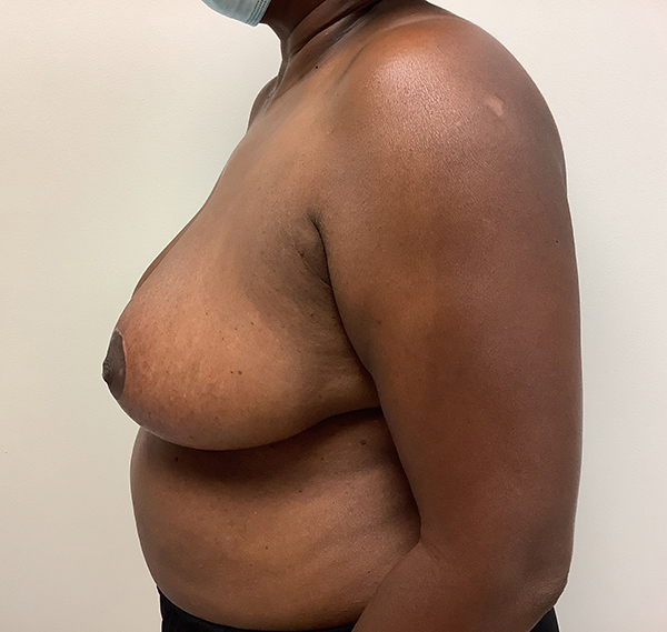 Breast Reduction - Before and After