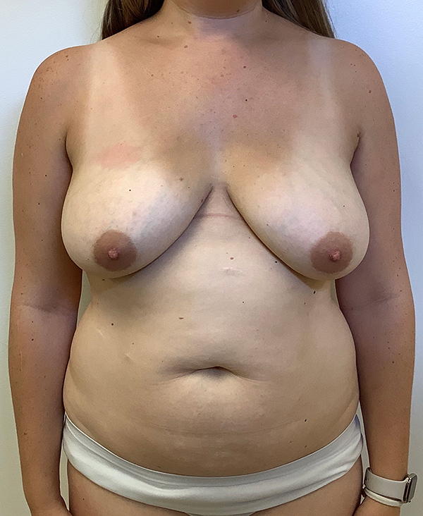 Multiple Cosmetic Surgeries - Before and After