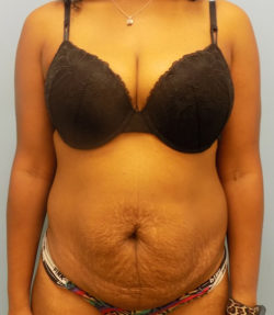 Abdominoplasty (Tummy Tuck) - Before and After