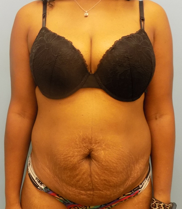 Abdominoplasty (Tummy Tuck) - Before and After