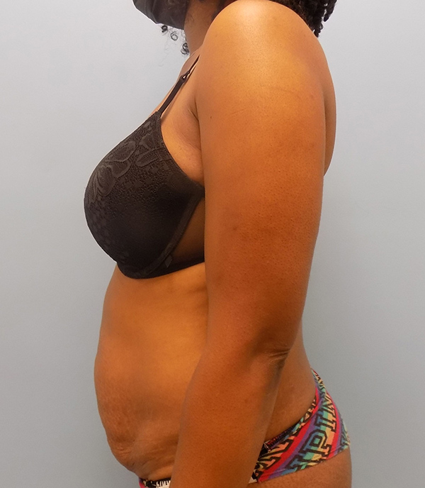 Abdominoplasty (Tummy Tuck) - Before and After