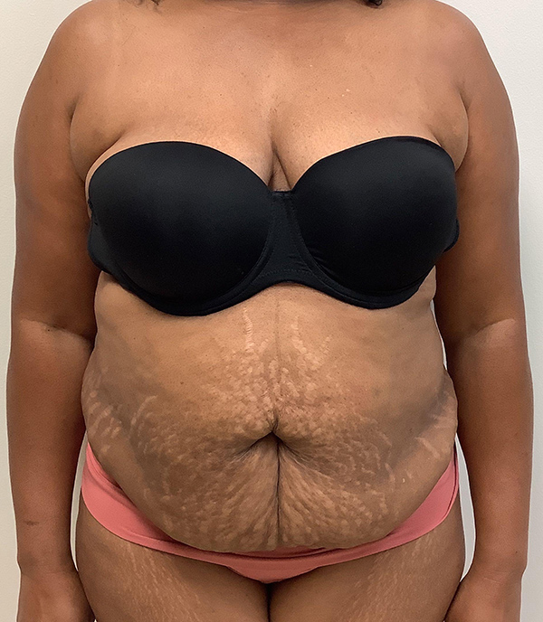 Abdominoplasty (Tummy Tuck) - Before and After