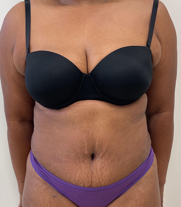 Abdominoplasty (Tummy Tuck) - Before and After