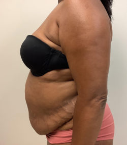 Abdominoplasty (Tummy Tuck) - Before and After