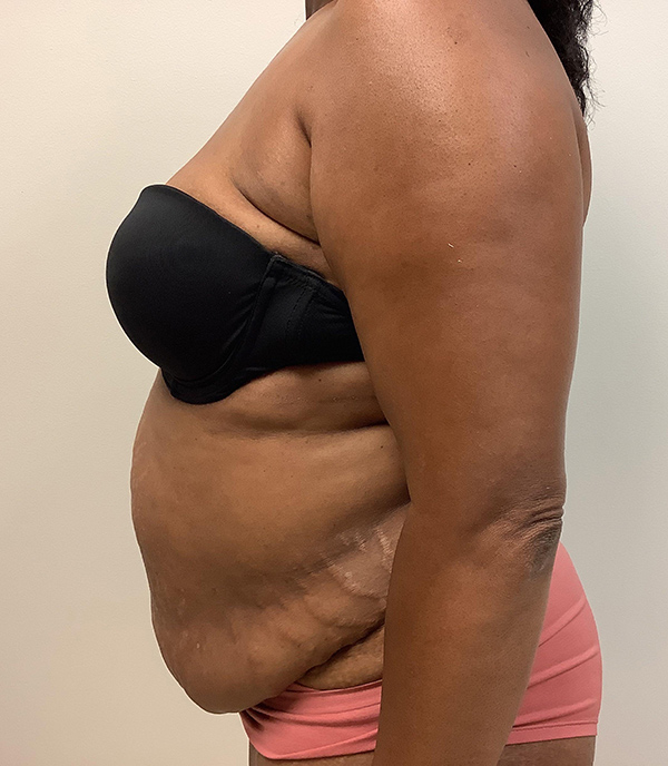 Abdominoplasty (Tummy Tuck) - Before and After