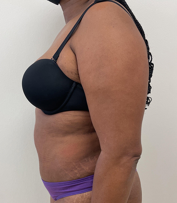 Abdominoplasty (Tummy Tuck) - Before and After