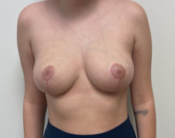 Mastopexy (Breast Lift) - Before and After Implants